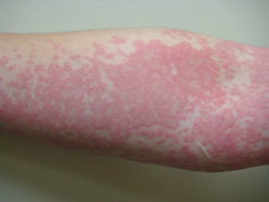hives on arm