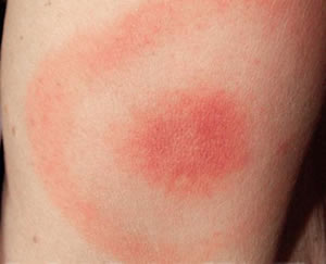 Lyme disease Erythema Migrans rash