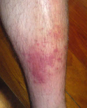 Cellulitis on the leg
