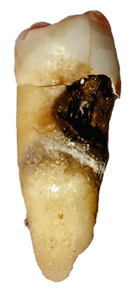Tooth with decay / caries. The bone holding this tooth also had decay